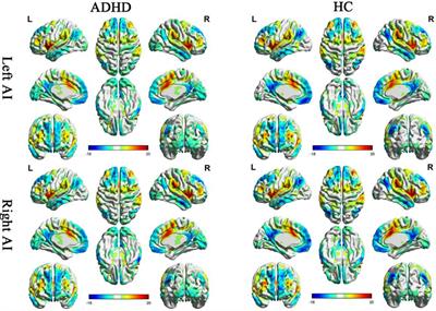 Abnormal Resting-State Functional Connectivity of Insular Subregions and Disrupted Correlation with Working Memory in Adults with Attention Deficit/Hyperactivity Disorder